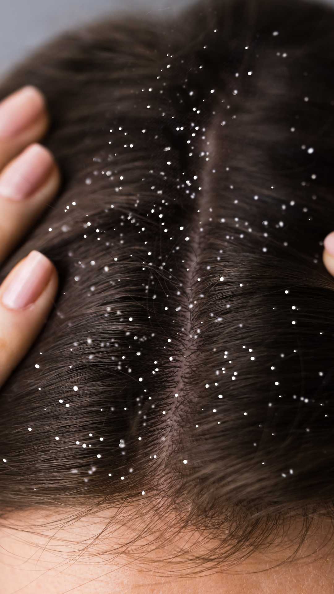 Featured-image-of-Woman-that-is-struggling-with-dandruff-and-flakes-on-her-scalp
